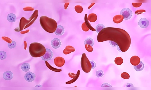 India Launches Affordable CRISPR Gene Therapy for Sickle Cell Disease