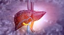 Global Fatty Liver Day | The rising threat of liver diseases — why screening matters