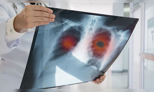 Lung Cancer Insurance: Understanding Coverage, Costs and Options