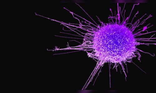 Global Cancer Crisis Hits Vulnerable Hardest