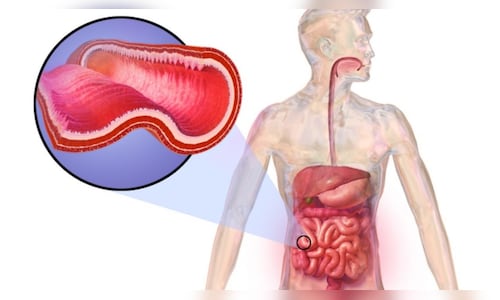 Crohn's Disease: Symptoms, and Body Impacts