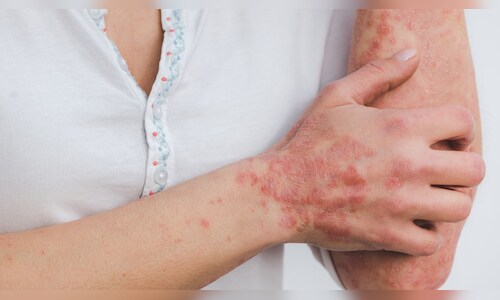 Measles Surge Puts US, Mexico at Risk of Losing Elimination Status