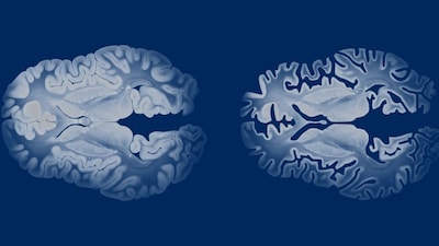 Alzheimer's Disease./Image Shutterstock