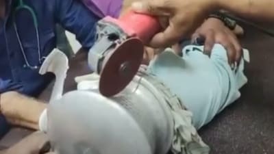 Maharashtra Doctors, Plumber Rescue 3-Year-Old with Head Stuck in Pot; Video Goes Viral