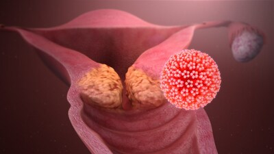 Cervical Cancer: Why Timely Screening is Crucial for Prevention