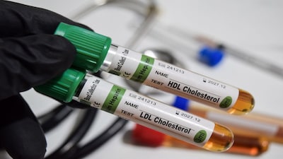 Cholesterol testing (Shutterstock)