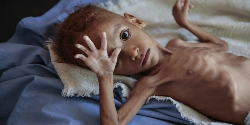 Over 33 lakh children in India malnourished, 17.7 lakh of them severely malnourished: Govt data