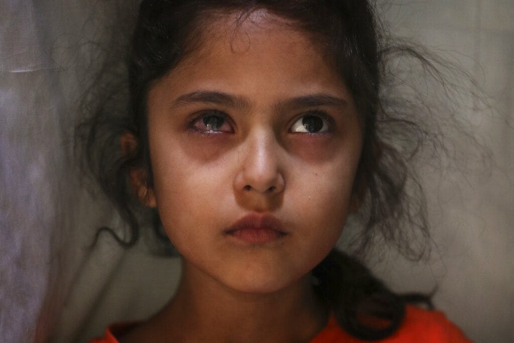 Six-year-old Muneefa Nazir, a Kashmiri girl whose right eye was hit by a marble ball shot allegedly by Indian paramilitary soldiers on Aug. 12, stands outside her home in Srinagar, Sept. 17, 2019. (AP Photo/Mukhtar Khan)