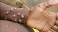 Monkeypox presents moderate risk to global public health, says WHO