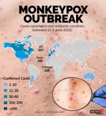 Monkeypox outbreak a pandemic, says body of scientists - CNBC TV18