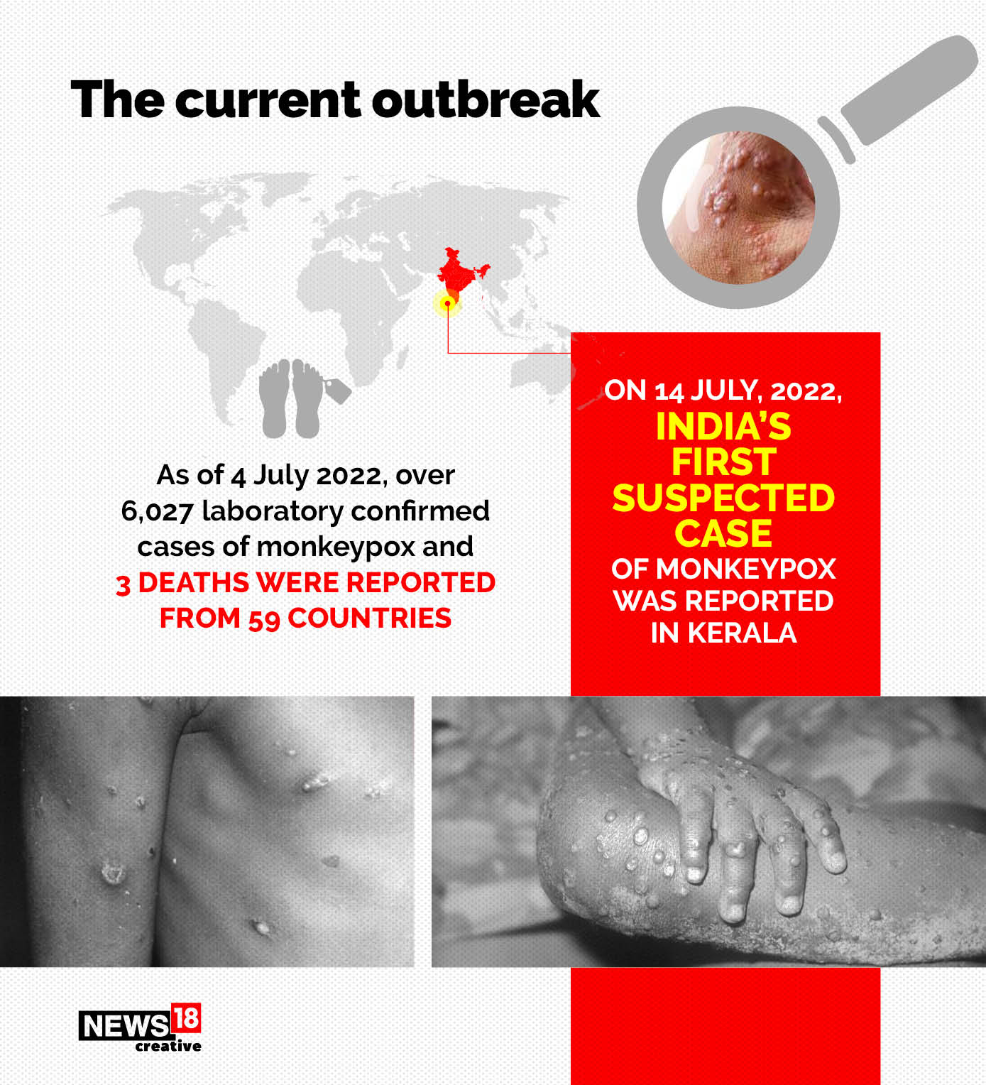 First Monkeypox Case Found In Kerala — Know All About The Disease Here