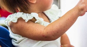 Nearly 12% of India's eligible children received no dose of measles vaccine, study finds
