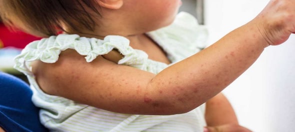 India ranks fourth in global measles outbreak — what's causing it