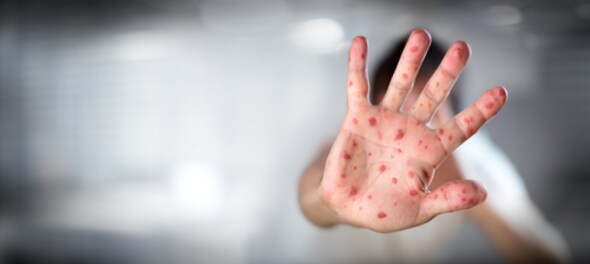 FAQ on measles outbreak — Vaccinations, advisories and areas affected