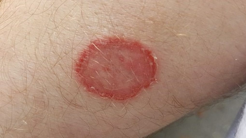 Ringworm on Tattoo: Is it Contagious? - wide 10