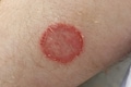 First instances of highly contagious ringworm strain found in US, check details here