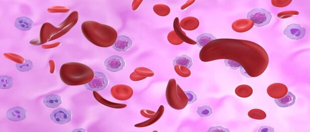 India releases new sickle cell anaemia guidelines — here’s all you need ...