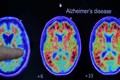 Indian clinical trial to assess glutathione therapy for effectiveness against Alzheimer's