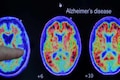 Indian clinical trial to assess glutathione therapy for effectiveness against Alzheimer's