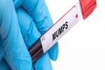 Mumps cases on the rise in Delhi-NCR, other states; why is this viral infection making a comeback?